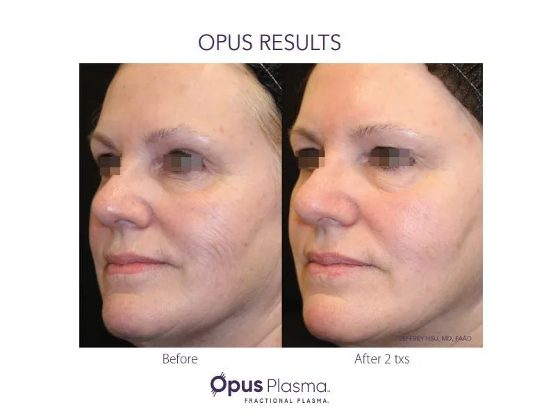 Opus Plasma cheek resurfacing before and after showing improved skin texture