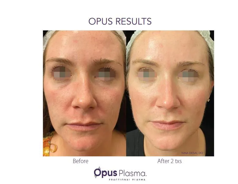 Opus Plasma full-face resurfacing before and after showing smoother tone and texture