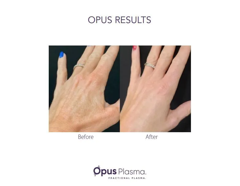 Opus Plasma hand rejuvenation before and after showing smoother skin appearance