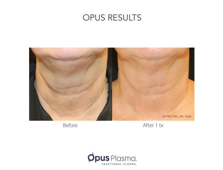 Opus Plasma neck rejuvenation before and after showing softer horizontal lines