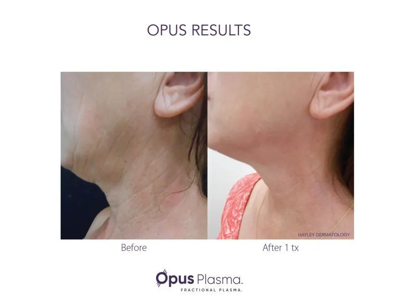 Opus Plasma under-eye resurfacing before and after showing smoother fine lines